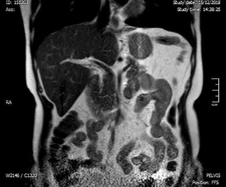 magnetna rezonanca abdomena beograd